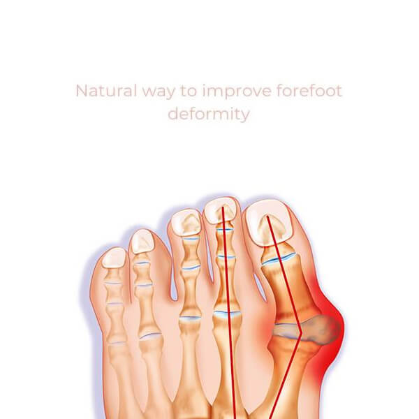 Corrector ortopédico de juanetes para los dedos del pie FIXEDFEET, 1 par (izquierdo + derecho)