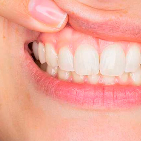 Limpador ultrassônico de dentes SMILY